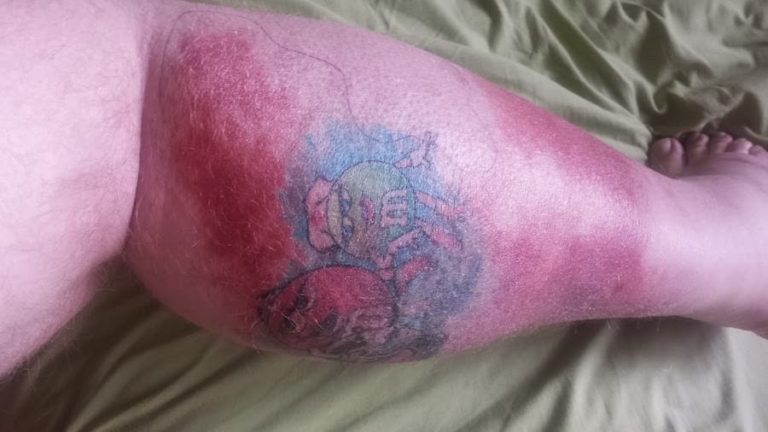 black ink infected tattoo